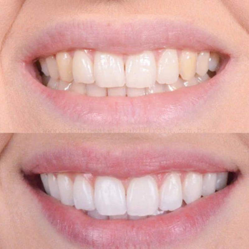 Sbiancamento rapido dei denti per un sorriso smagliante