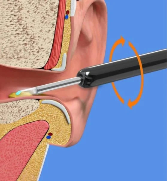 ProScope™ Smart Ear Cleaner